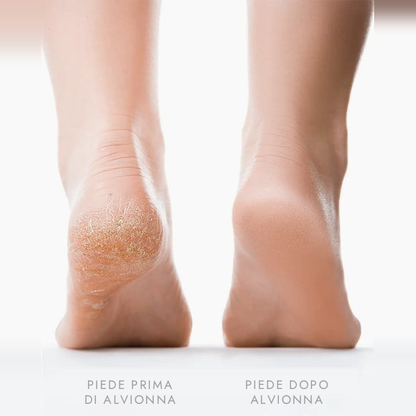 Piede prima e dopo Alvionna