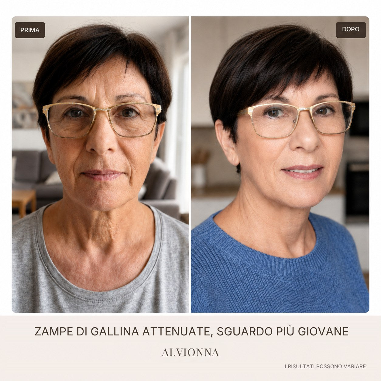 Prima e dopo zampe di gallina