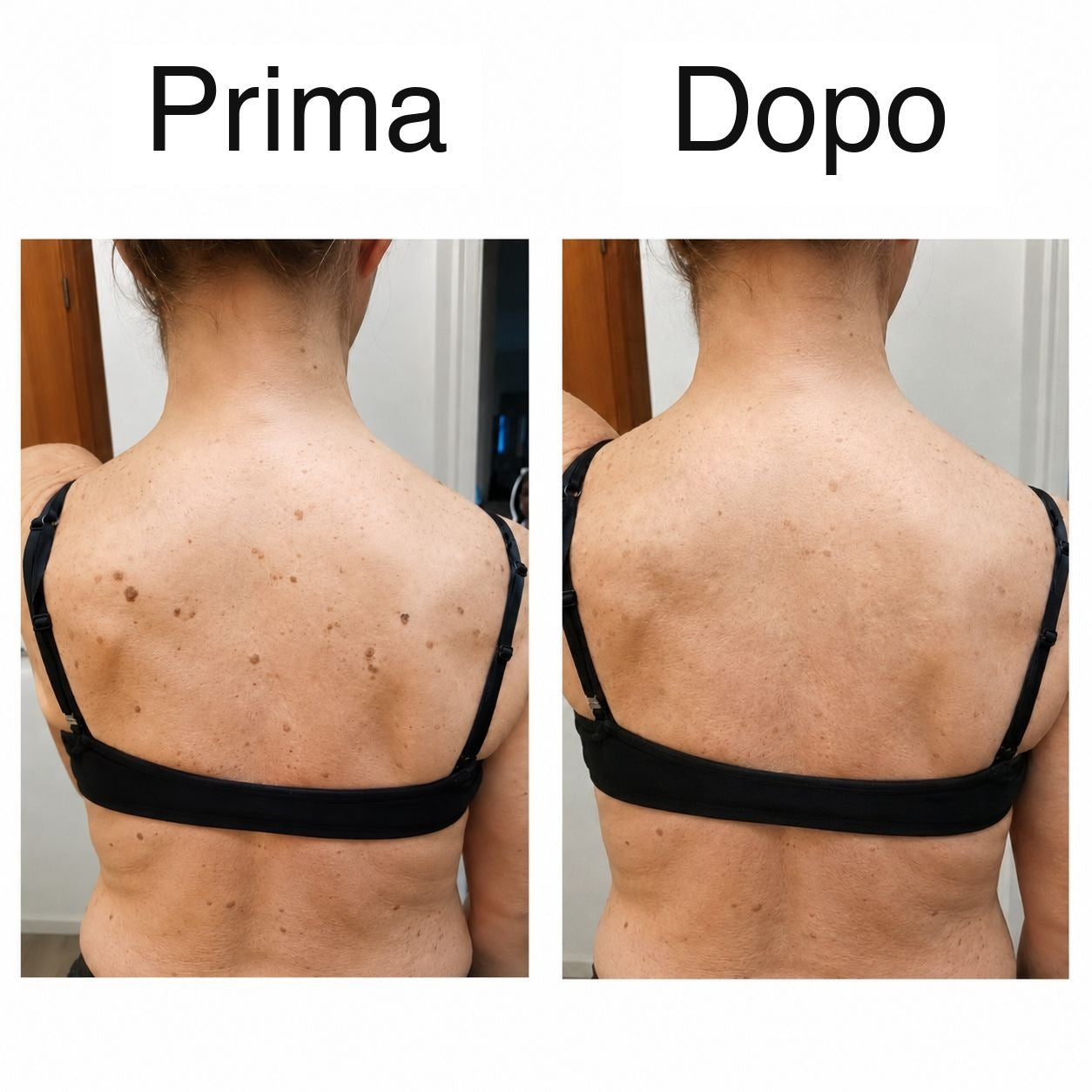 Prima e dopo sulla schiena