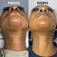Prima e Dopo - Mento