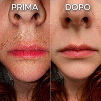 Prima e Dopo - Labbro superiore