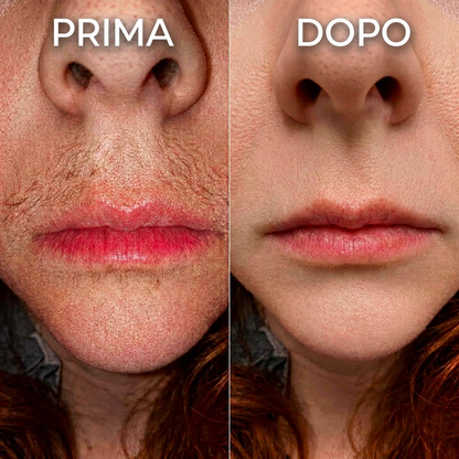 Prima e Dopo - Labbro superiore